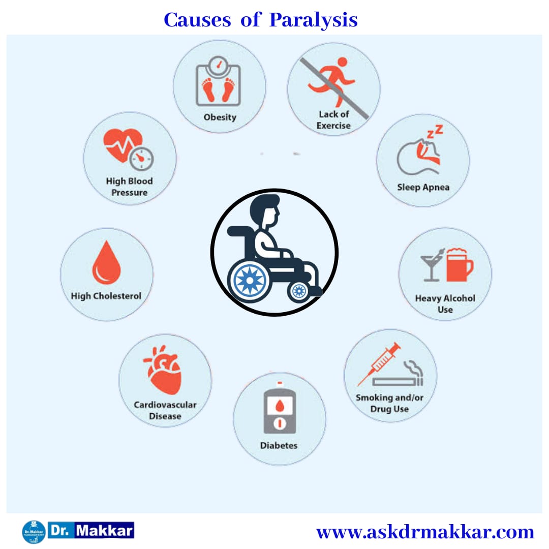 Cause of Paralysis || लकवा मारना पक्षाघात के कारण