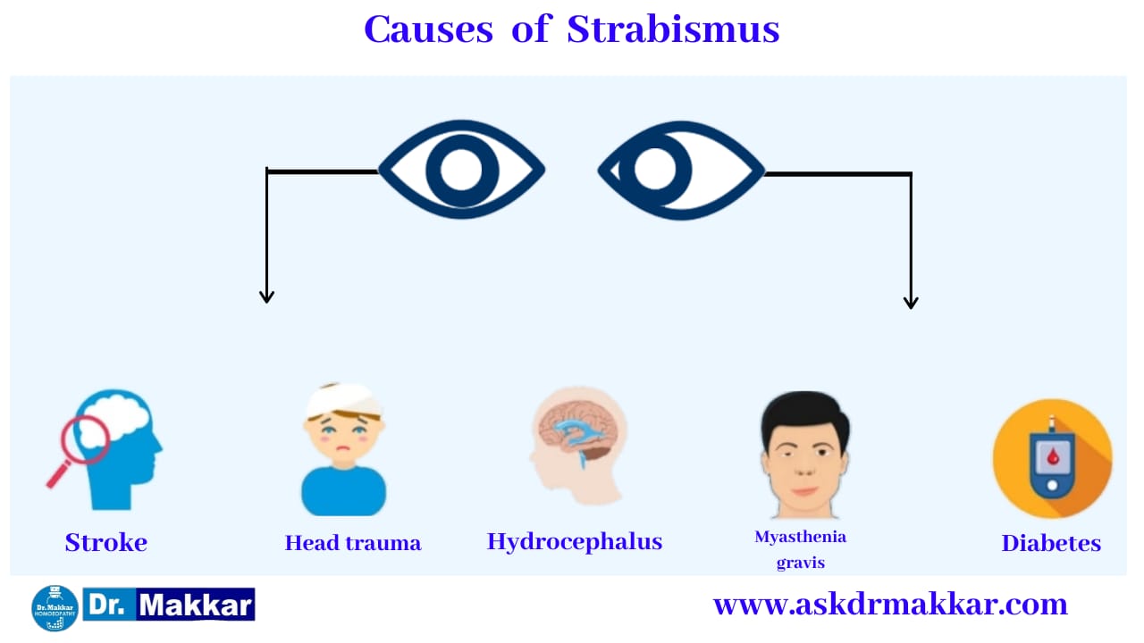 Cause of Strabismus Crossed Eye ||  भेंगापन  तिर्यकदृष्टि  स्ट्राबिस्मस के कारण