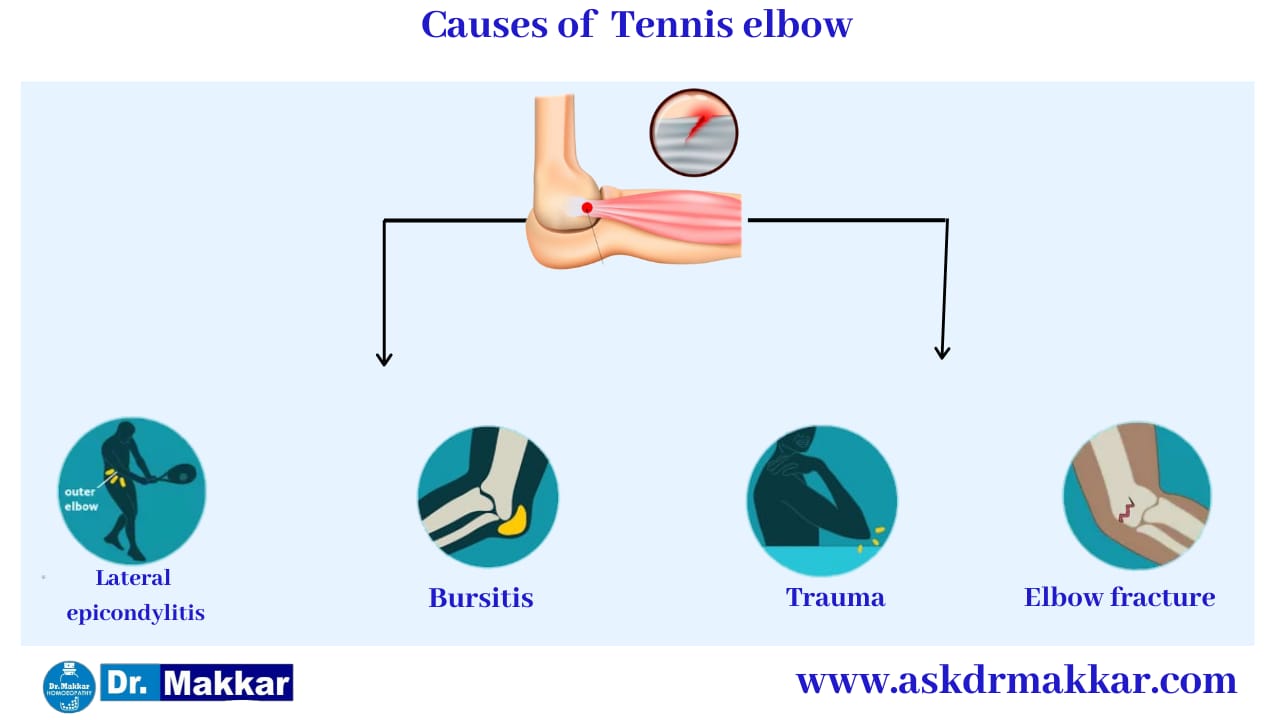 Cause of Tennis Elbow || टेनिस एल्बो के  कारण