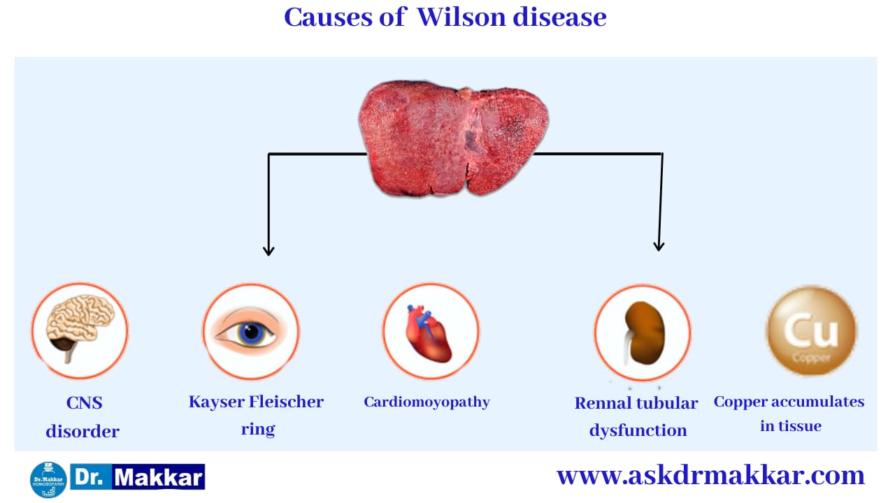 Cause of Wilson Disease   विल्सन रोग के कारण