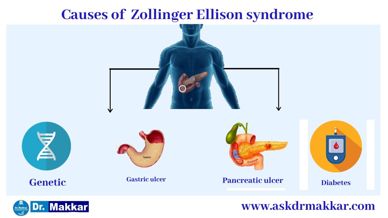Causes of Zollinger-Ellison syndrome || ज़ोलिंगर एलिसन सिंड्रोम के कारण