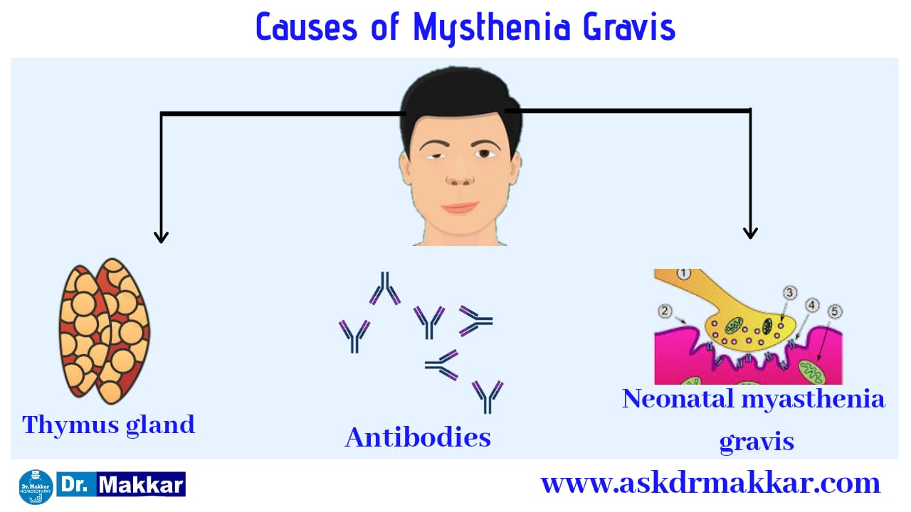 Causes Mysthenia Gravis Real Reason behind it
