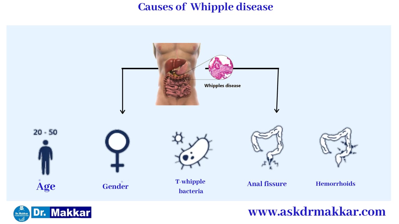 Causes Of Whipple Disease || व्हिपल रोग के कारण
