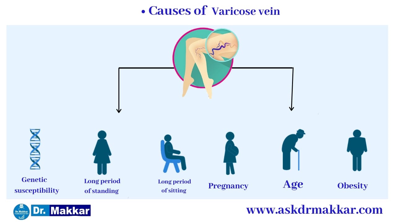 Varicose vein Causes for development of varicosity  ||  वैरिकोसिटी के विकास के कारण