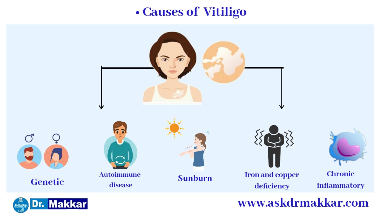 Causes for vitiligo leucoderma white patches || विटिलिगो ल्यूकोडर्मा सफेद दाग के कारण