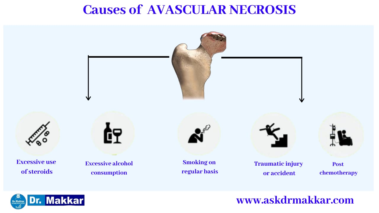 Causes of Avascular Ischemic Necrosis AVN Osteonecrosis femur  || एवस्कुलर इस्केमिक नेक्रोसिस एवीएन ओस्टियोनेक्रोसिस फीमर हड्डी के कारण
