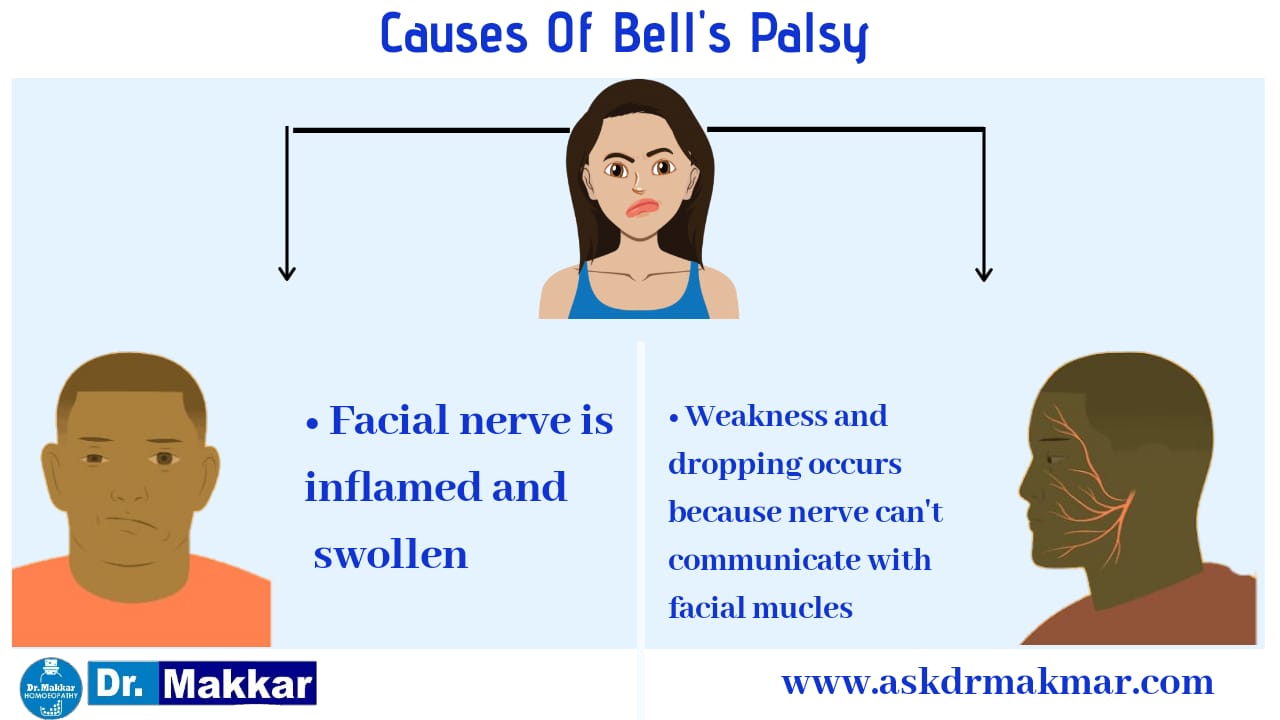 Causes of Bells Palsy india punjab homeopathic 