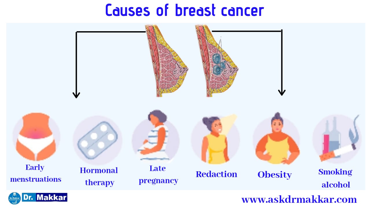 Causes of  Breast Tumour leads to Breast Cancer