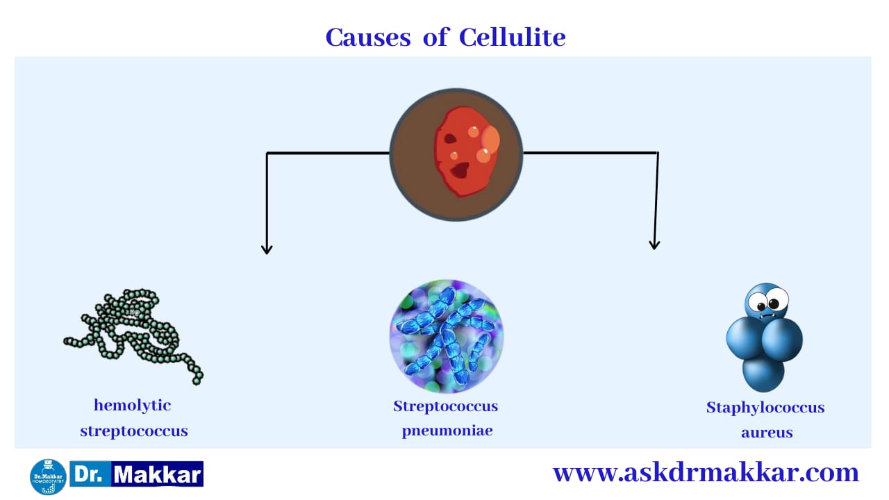 Causes of Cellulitis Skin Infection || सेल्यूलाइटिस स्किन इंफेक्शन के कारण