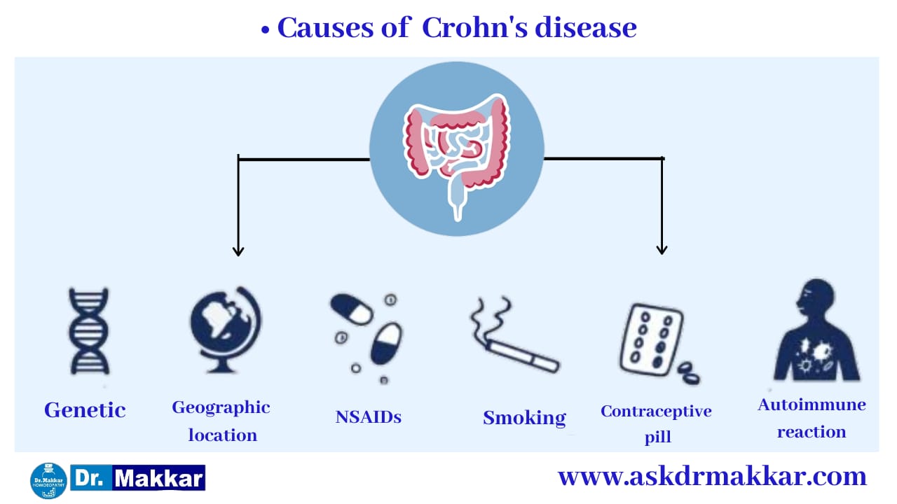 Causes of Crohns Disease Inflammation of intestine || आंतों में सूजन क्रोहन रोग के कारण