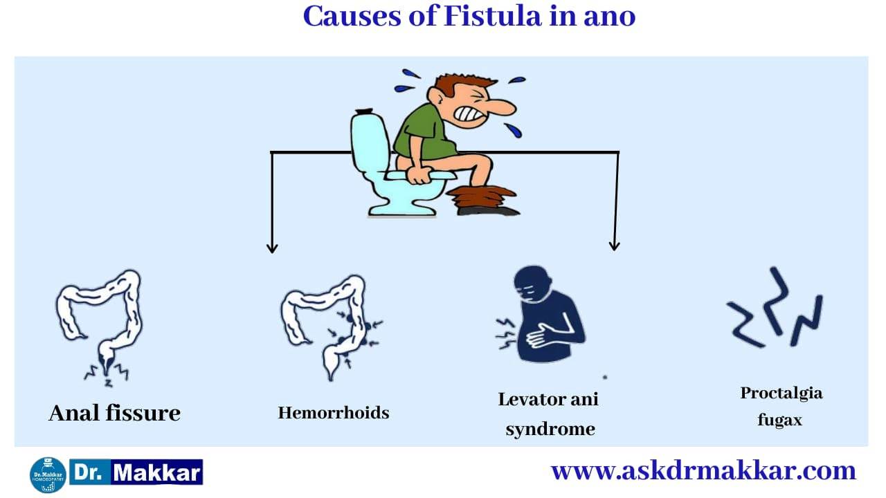 Causes of Fistula also called as fissure in ano || भगन्दर एनल फिस्टुला के कारण