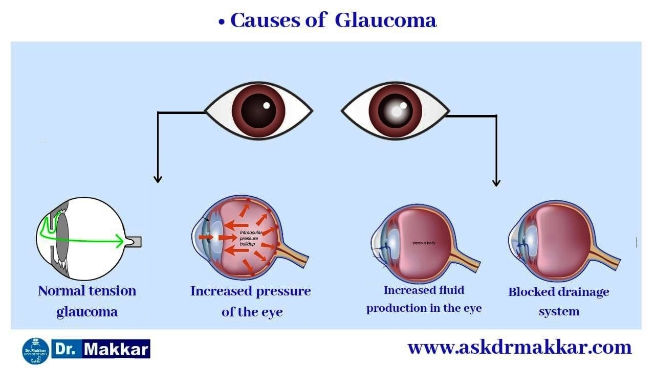 Causes of Glaucoma || ग्लूकोमा के कारण