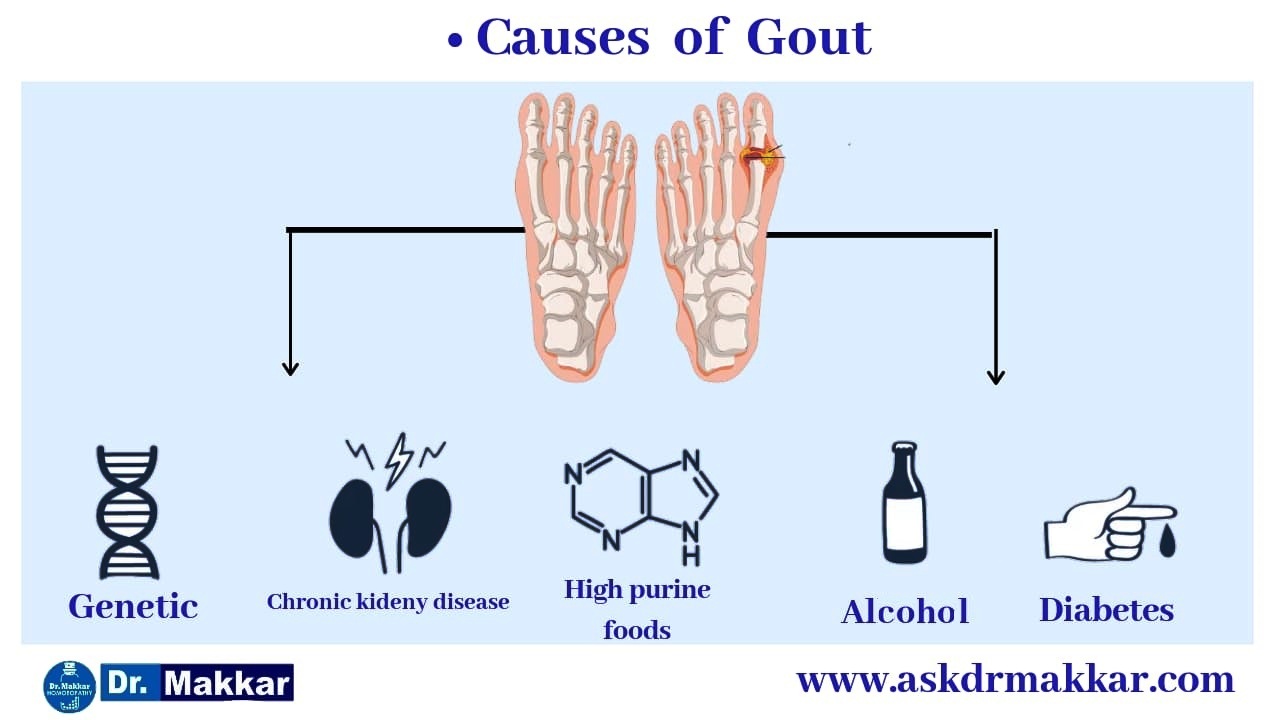 Causes of Gout Uric Acid