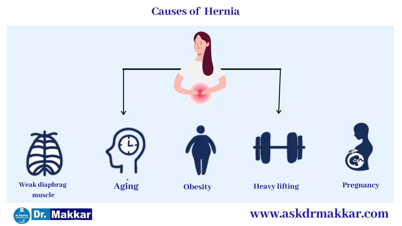 Causes of Hernia   हर्निया के कारण