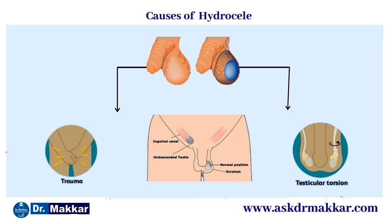 Causes of Hydrocele || हाइड्रोसेले के कारण