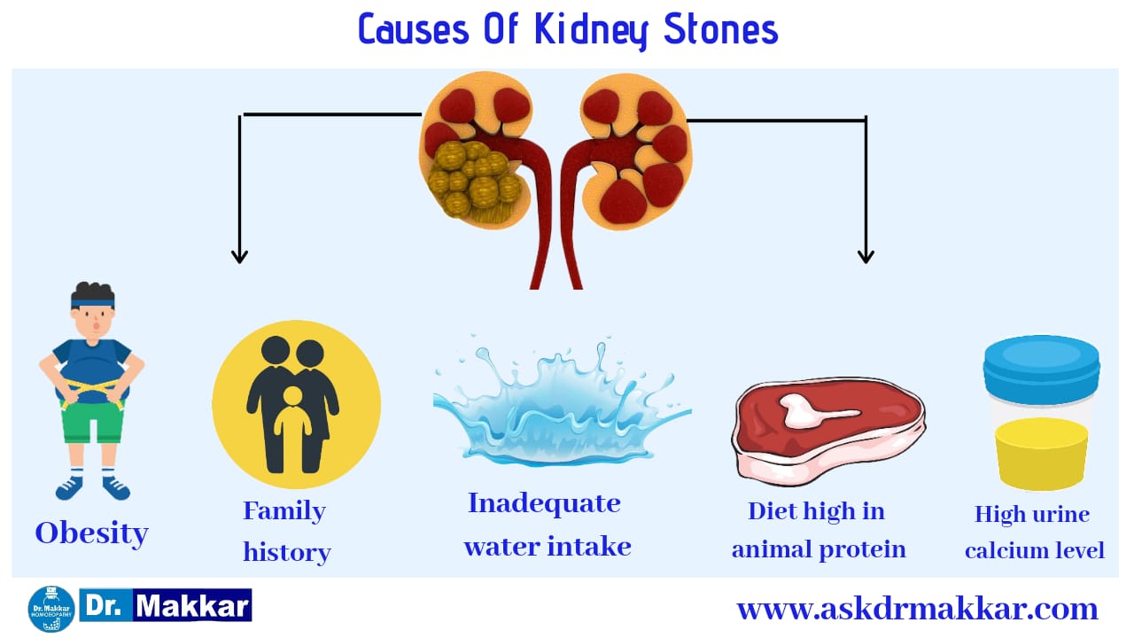 Causes of Kidney stones Urolithiasis  renal calculi, nephrolithiasis or urolithiasis