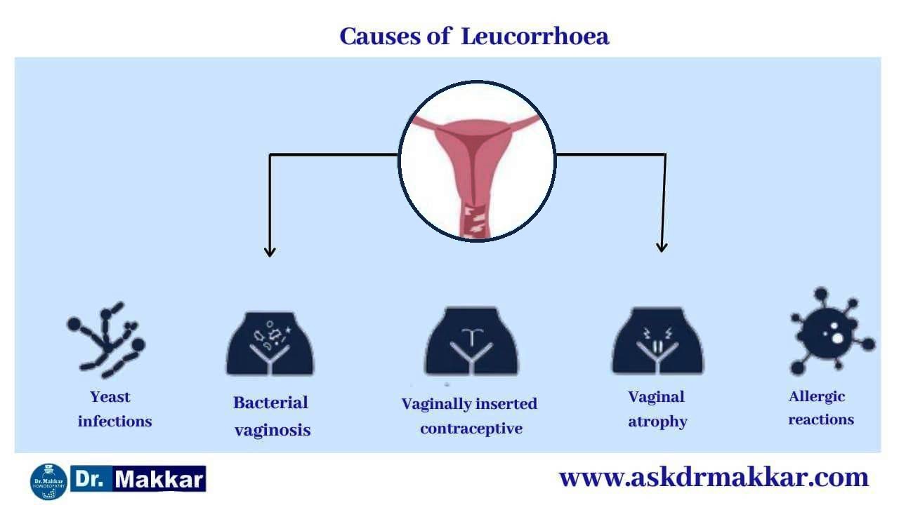 Causes of Leucorrhoea White Discharge || ल्यूकोरिया श्वेत प्रदर के कारण