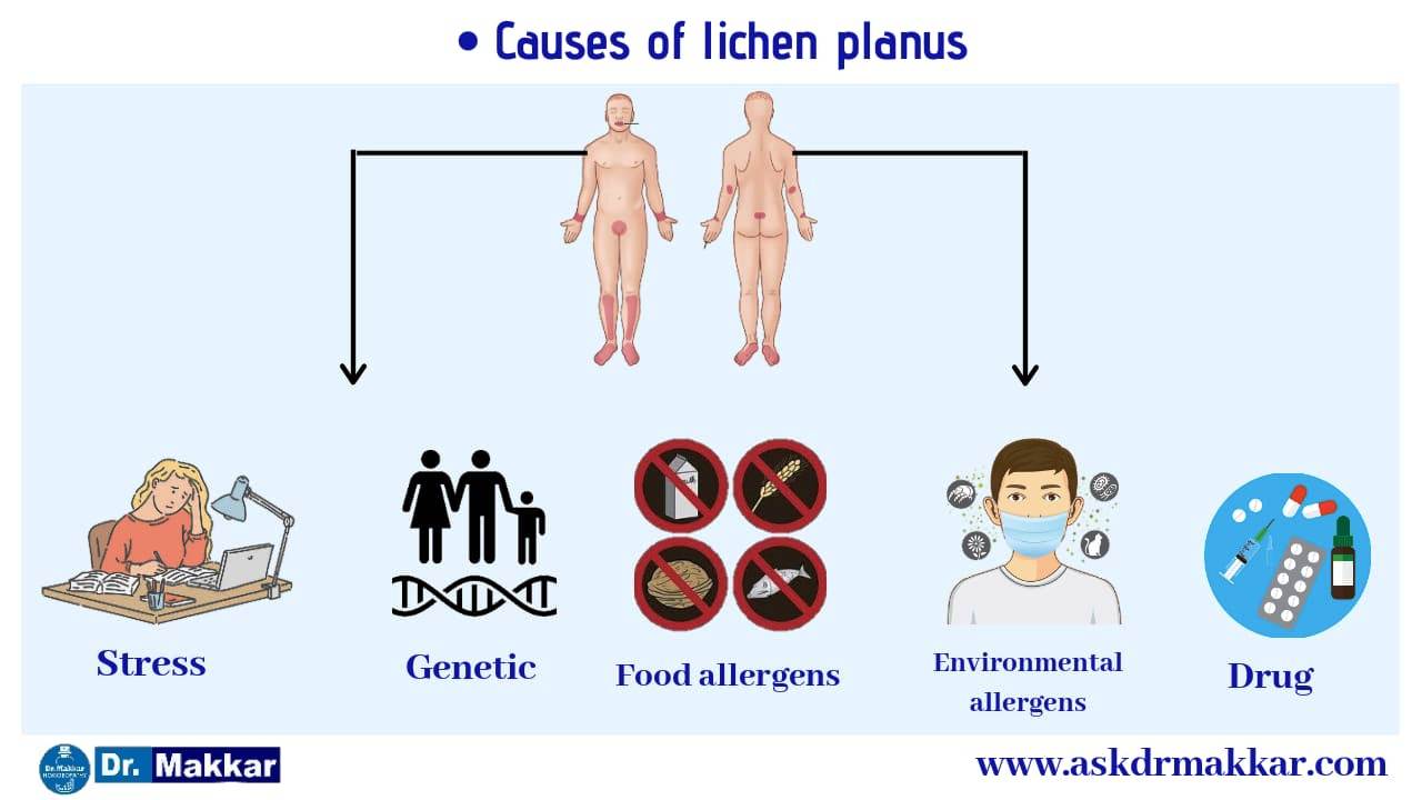 Causes of Lichen Planus,genetic,stress,enviourmental factors,,stress,drugs Cause  of lichen planus || लाइकेन प्लेनस के प्रकार लिए जोखिम कारण