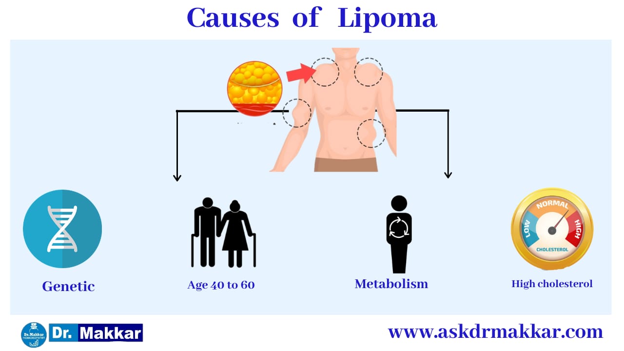 Causes of Lipoma Benign Tumour under skin || चर्बी की गांठ लिपोमा के कारण