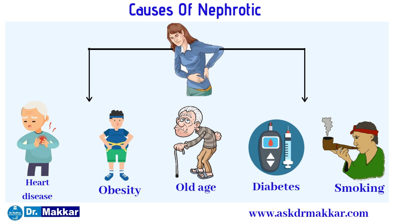Causes of Nephrotic disease