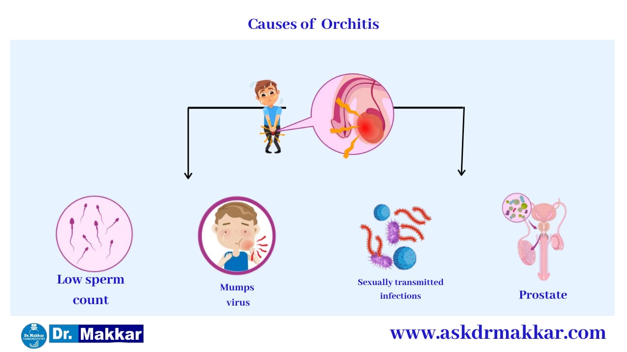 Causes of Orchitis || ऑर्काइटिस के कारण