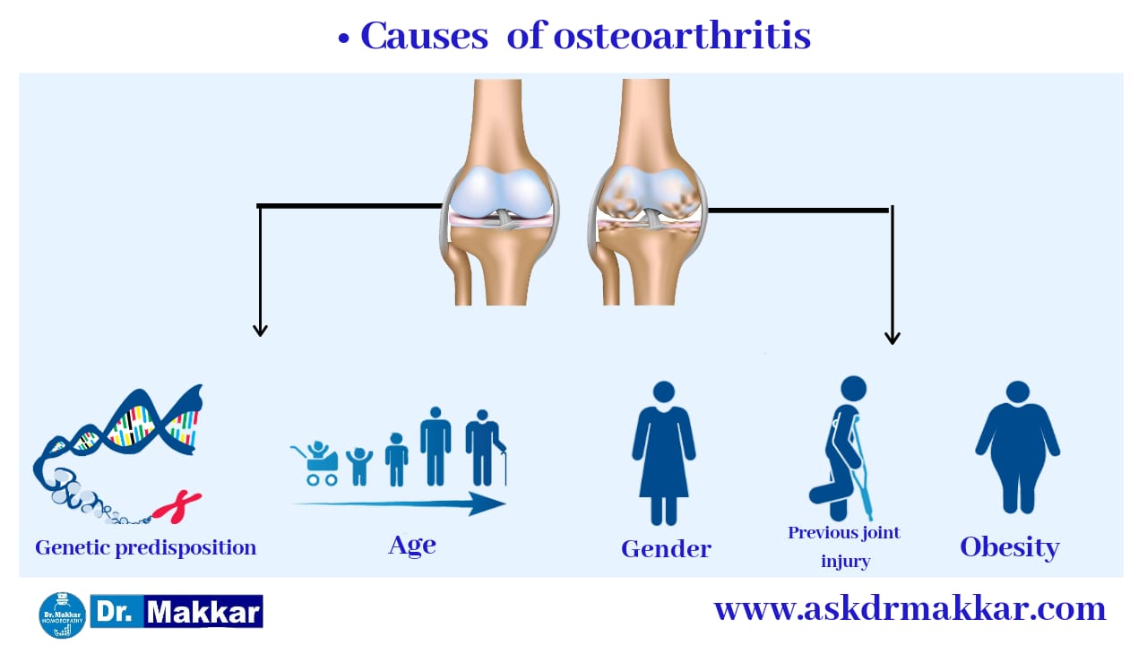 Causes of Osteoarthritis 