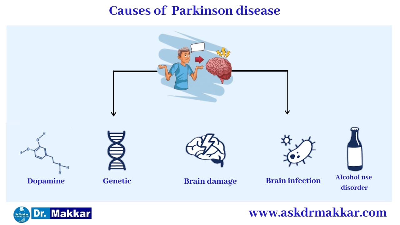 Causes of Parkinson Disease || पार्किंसन डिजीज तंत्रिका तंत्र के कारण