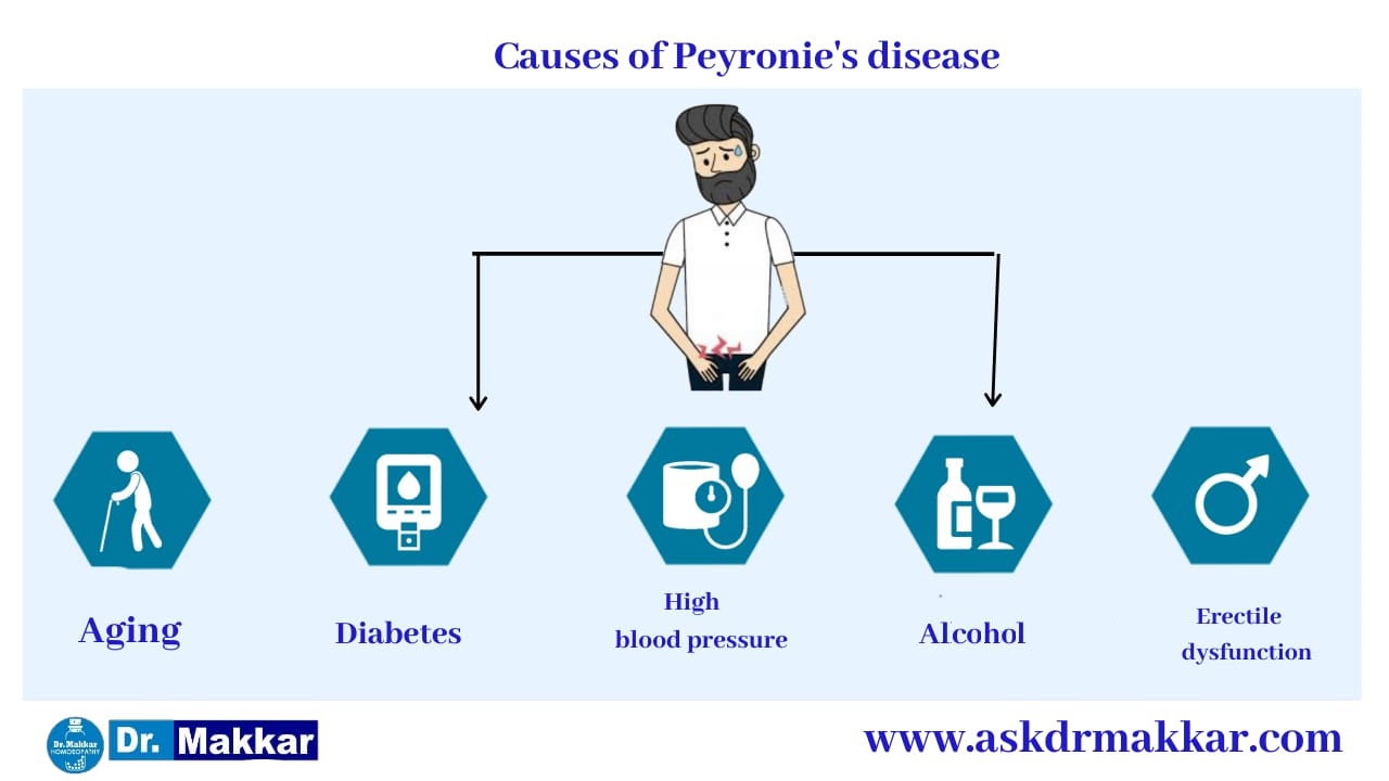 Causes of Peyronies disease curved Penis || पेयरोनी डिजीजलिंग का टेढ़ापन मुंडा लिंग रोग के कारण