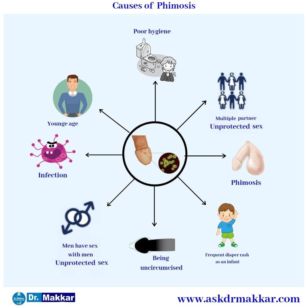 Causes of Phimosis || फाइमोसिस या निरुद्धप्रकाश शिश्न के कारण