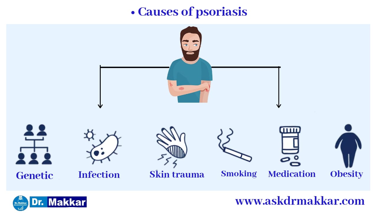 Causes of Psoriasis सोरायसिस होने के कारण