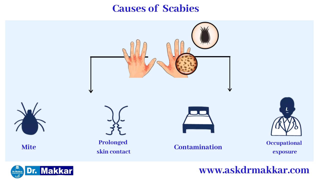 Causes of Scabies || स्केबीज या खाज के कारण
