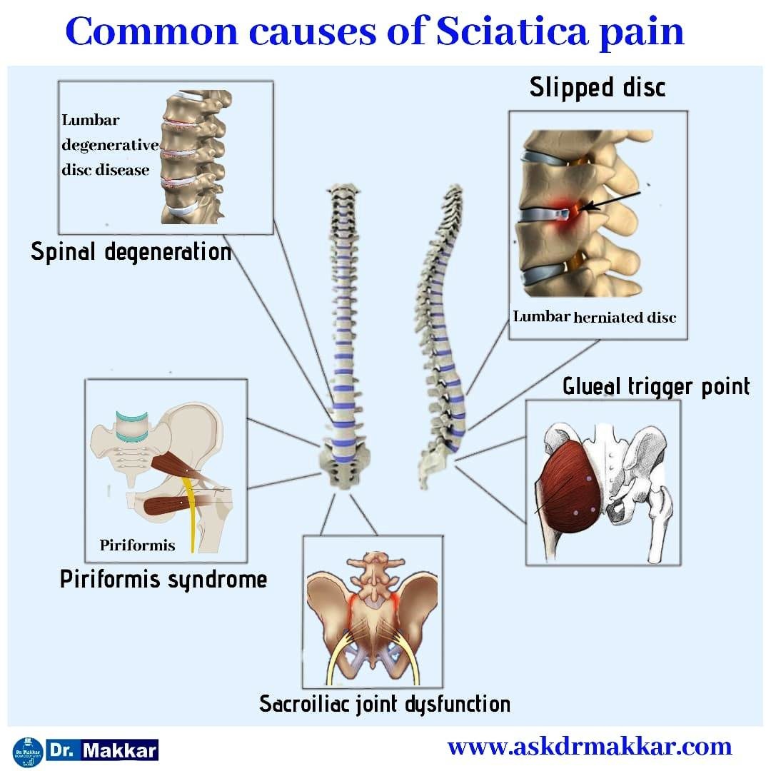 Causes of Sciatica Lumber rediculopathy Sciatica Nerve comression Causes of Sciatica Lumber rediculopathy Sciatica Nerve comression  || साइटिका कटिस्नायुशूल के कारण