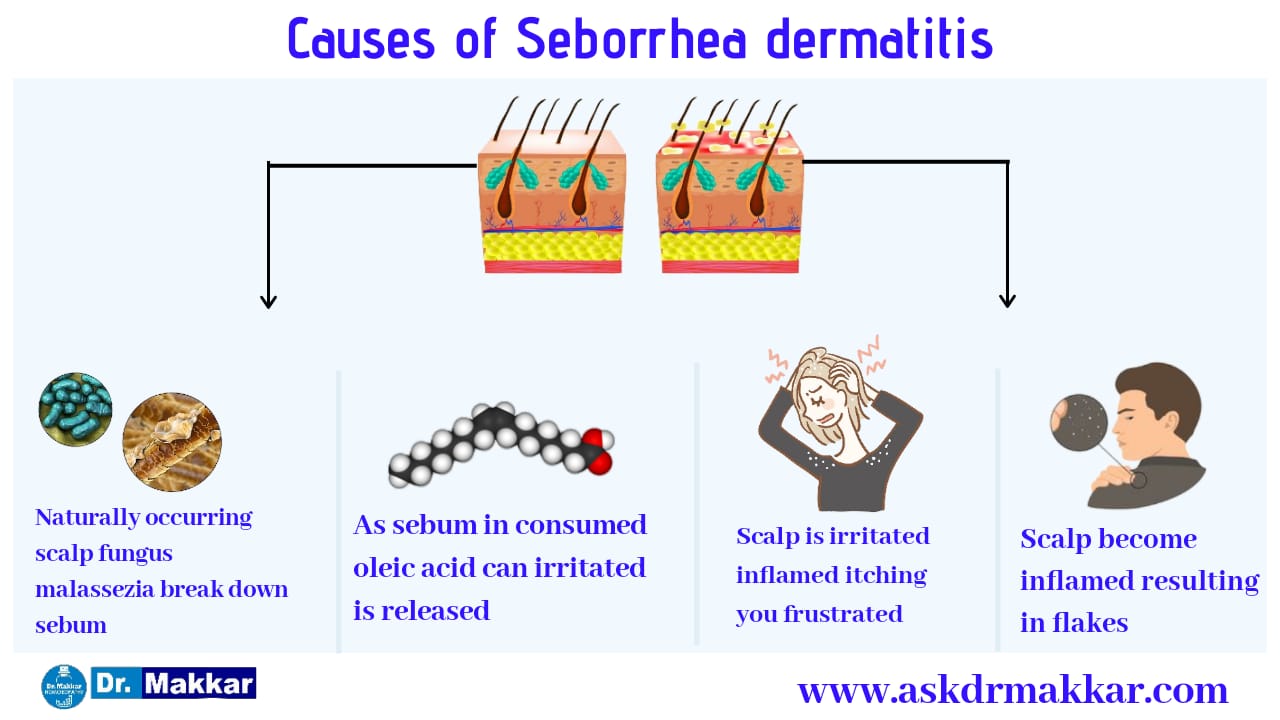 Causes of Sebrrhic dermatitis