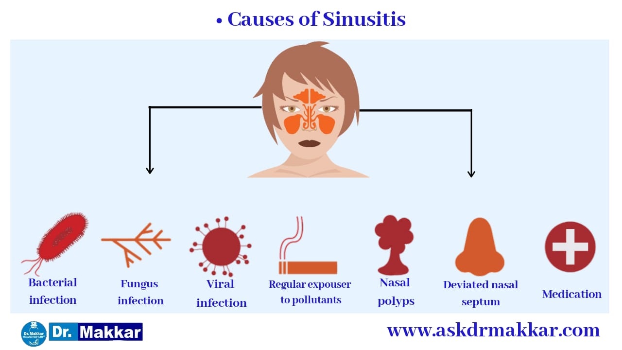 Causes of Sinusitis in detail bacterial fungal viral nasal septum deviated 