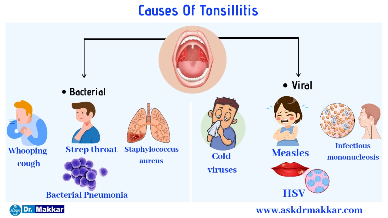 Causes of Tonsillitis 