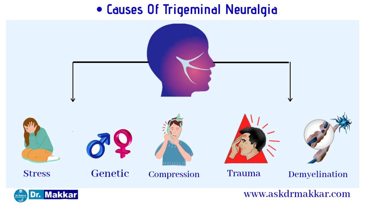 Causes of Trigerminal Neuralgia