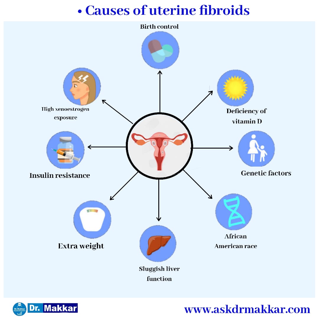 Causes of Uterine fibroid also called as myoma || गर्भाशय फाइब्रॉएड के कारण जिन्हें मायोमा भी कहा जाता ह
