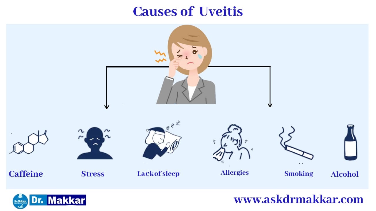 Cause of Uveitis eye disease  ||  यूवाइटिस आंखों से संबंधित रोग के कारण