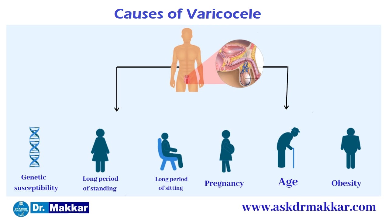 Causes of Varicocele || वैरिकोसेले के कारण