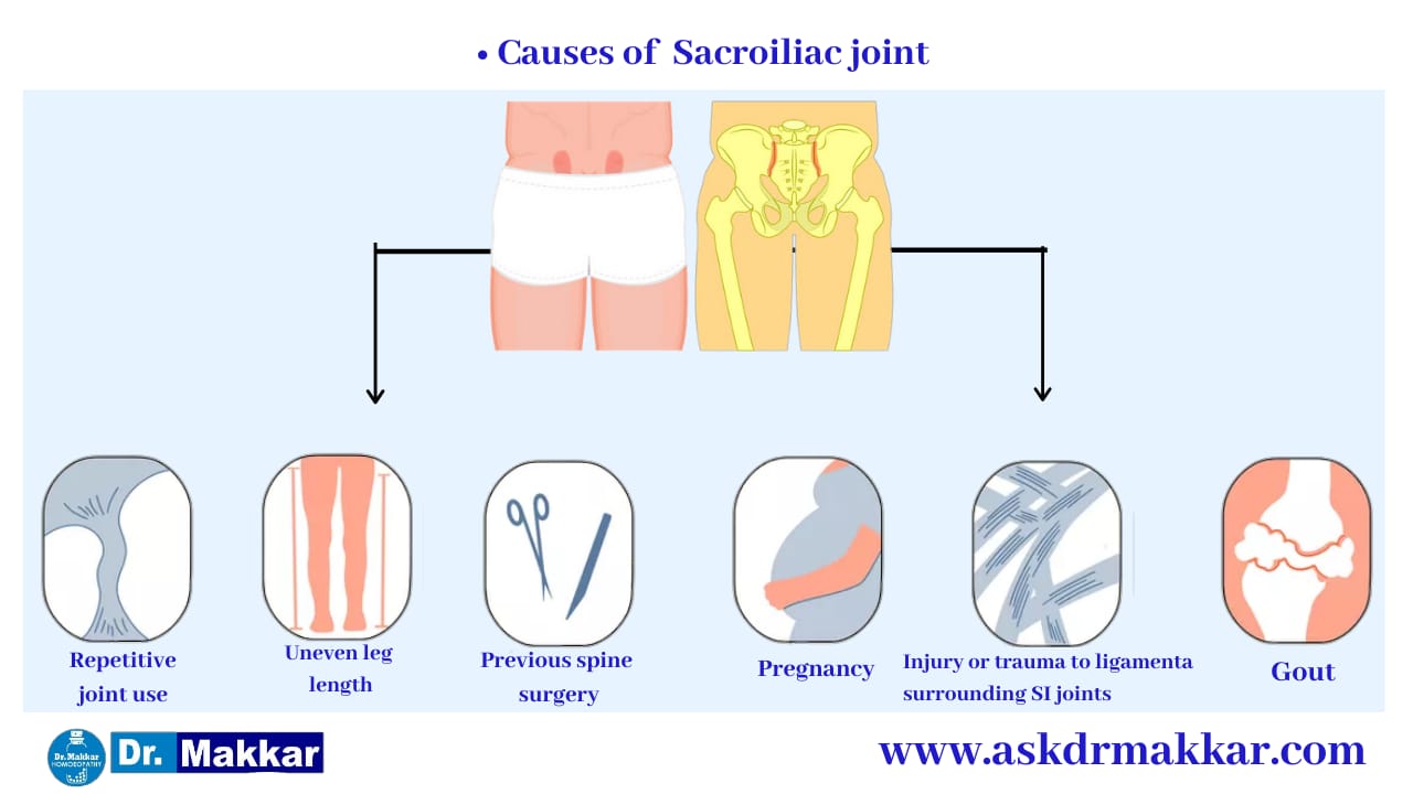 Causes of e Sacroiliac Joint Dysfunction SI Joint Pain || सैक्रोइलियक संयुक्त रोग जोड़ों का दर्द के कारण