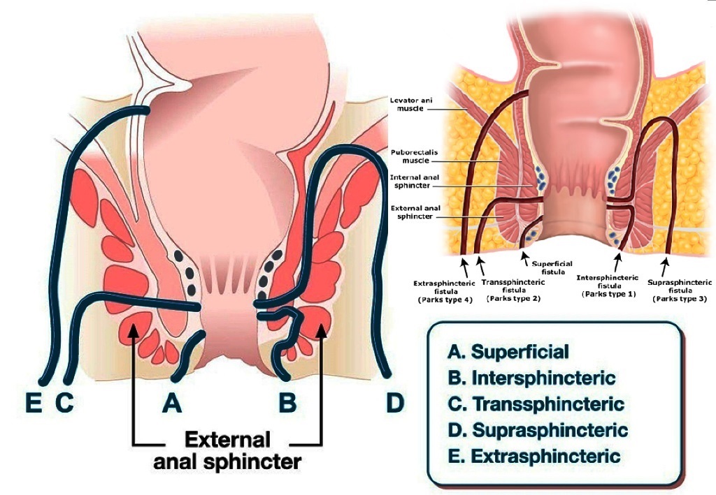 Classification of Fistula also called fissure in ano || भगन्दर एनल फिस्टुला के प्रकार