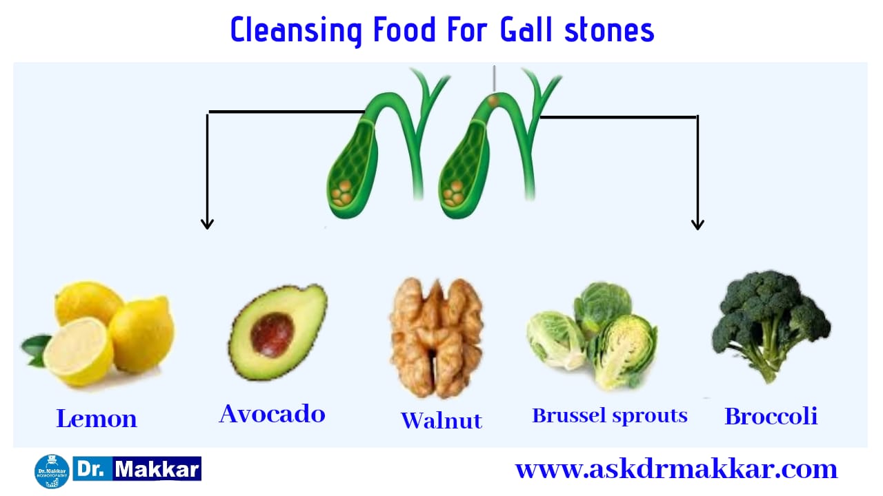 Cleansing food for gall stones Cholelithiasis