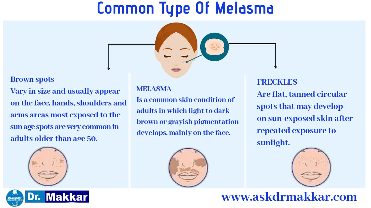 	Common Type of malesma cholasma