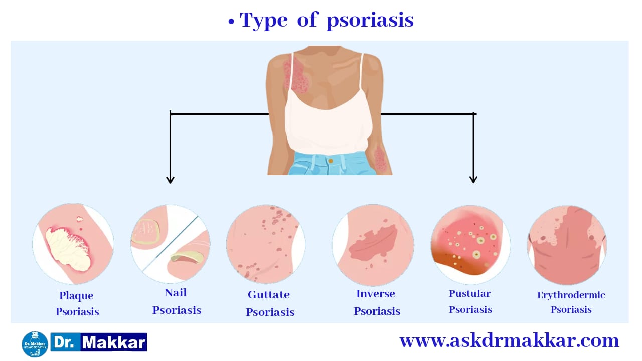 Commonly recognized types of Psoriasis सोरायसिस का आमतौर छाल रोग)  पहचानने योग्य