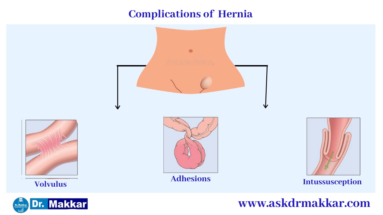 Complication in  Hernia  हर्निया के उपचार में जटिलता