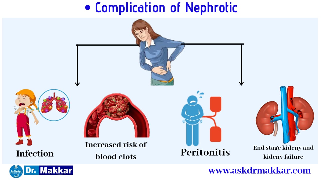 Complication of Neprotic Disease