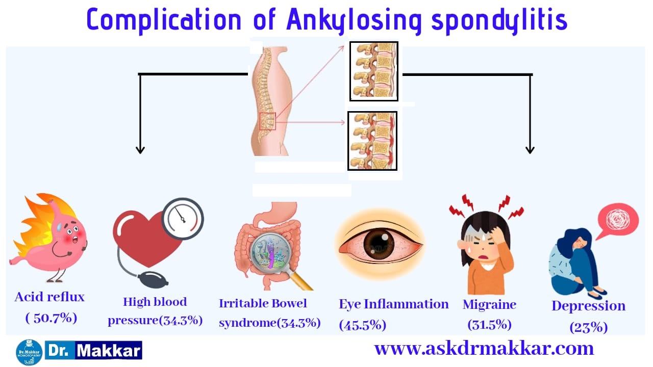 Complication of ankylosing Spondolysis in detail