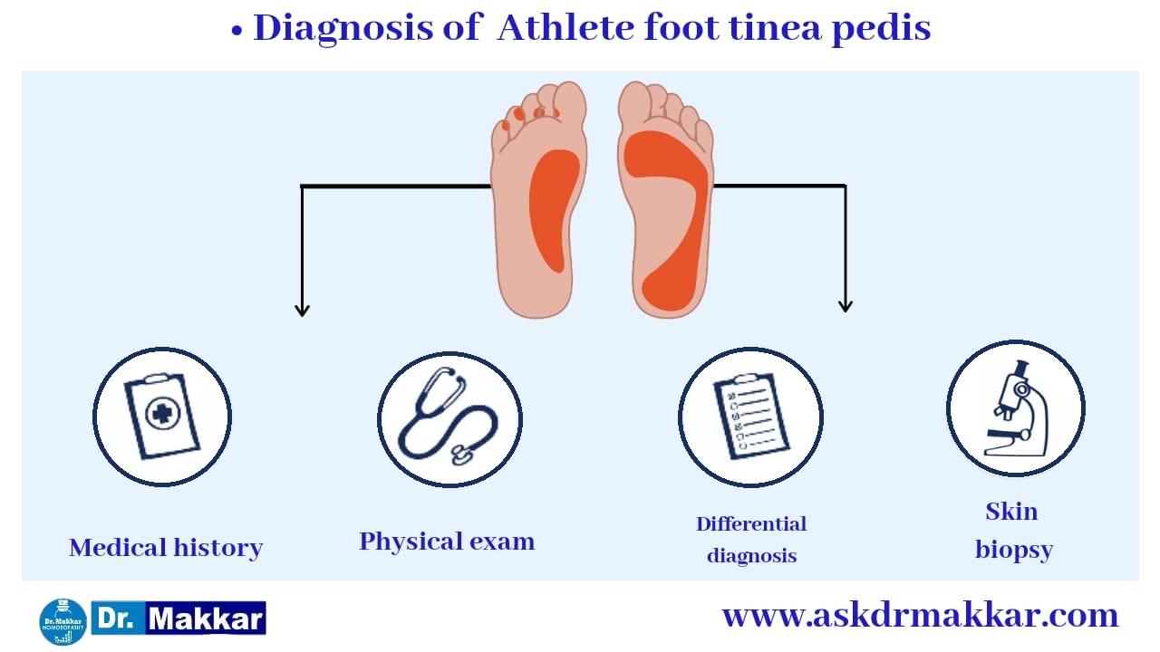 Diagnosing criteria for tinea pedis or athlete feet || टिनिया पेडिस या एथलीट फुट के लिए मानदंड का निदान करना