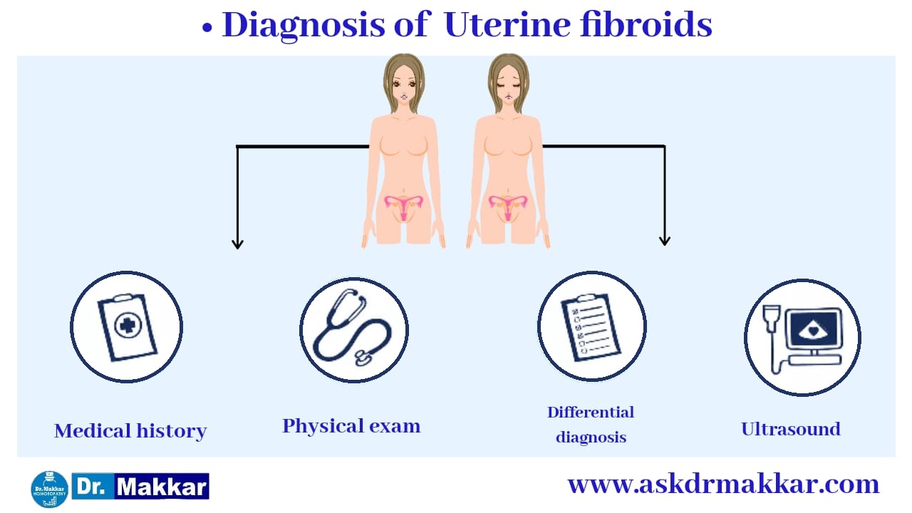 Diagnosis Exams and Tests for Uterine fibroid also called as Myoma || गर्भाशय फाइब्रॉएड के लिए निदान परीक्षा और परीक्षण जिसे मायोमा भी कहा जाता है