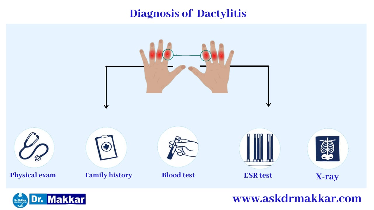 Diagnosis and investigations for Dactylitis Swelling in Digits Toes Fingers || डक्टाइलिटिस की मूल्यांकन  जाँच पड़ताल हाथ पैरों की सूजन 